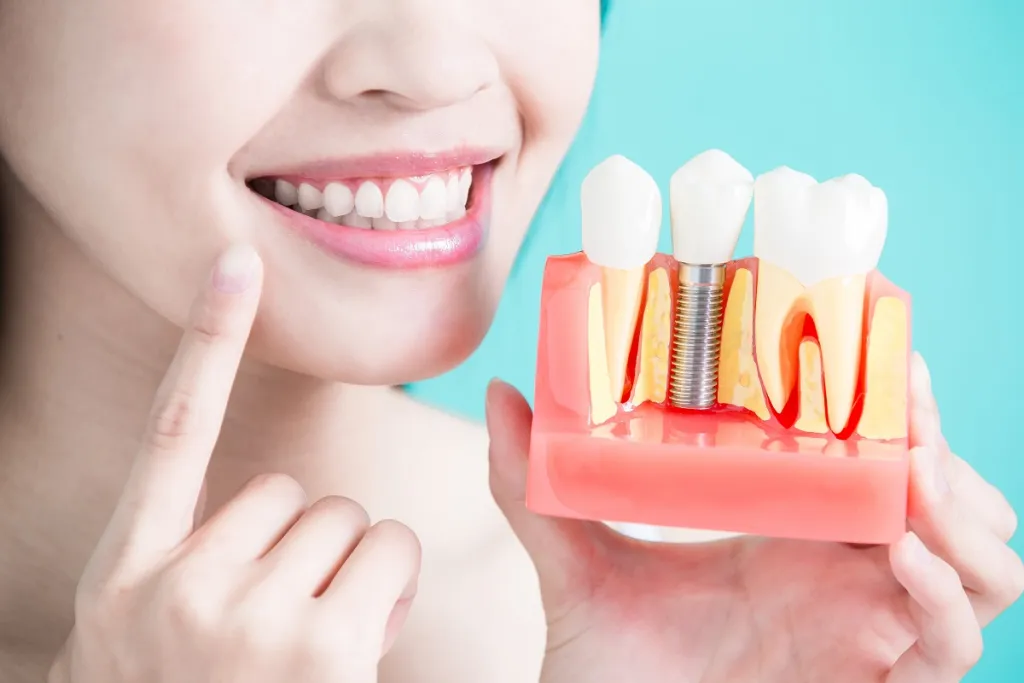 What to Expect With Dental Implants