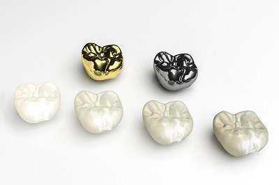 How Important is Your Choice of Dental Crown Material?